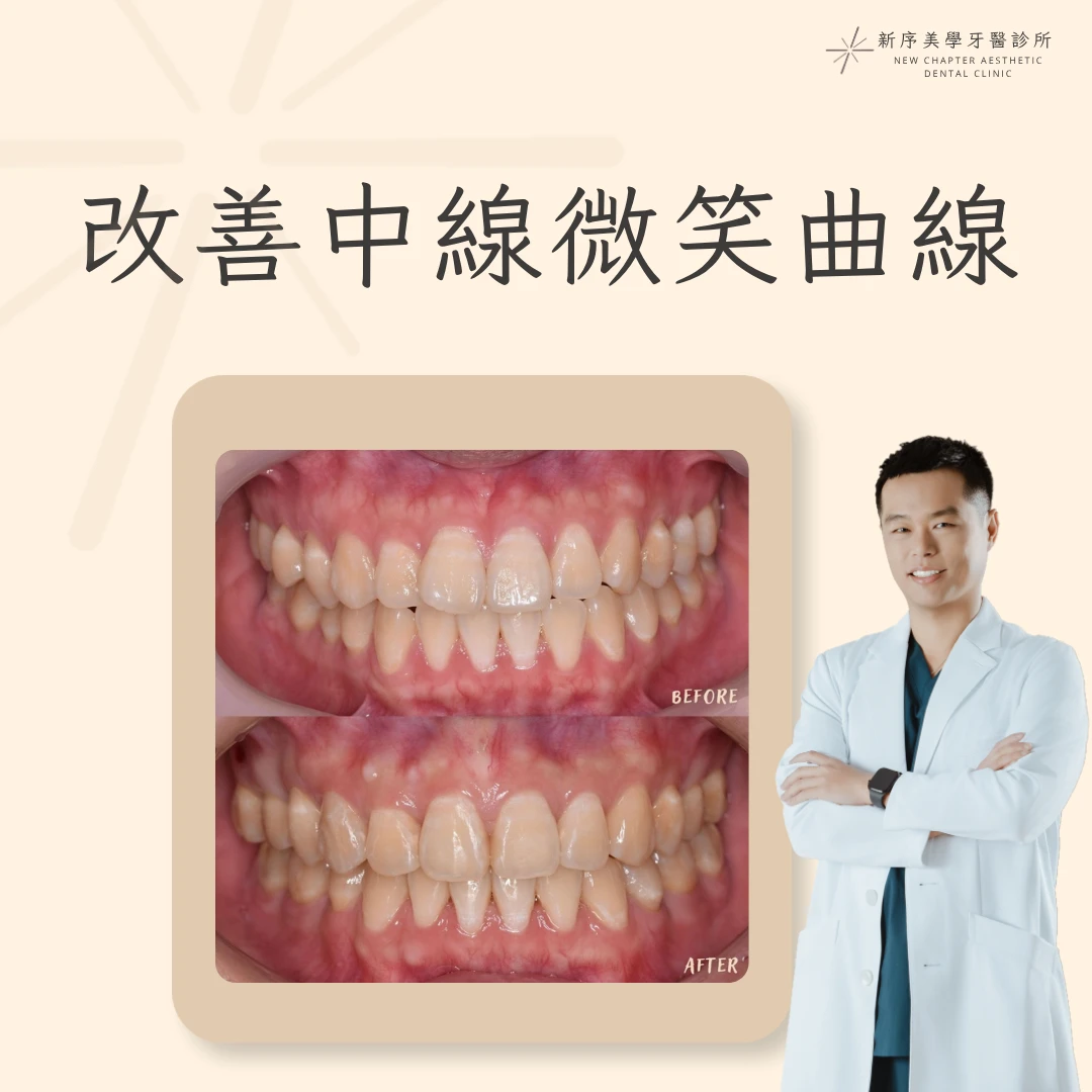 改善中線微笑曲線案例｜林建宏醫師案例分享