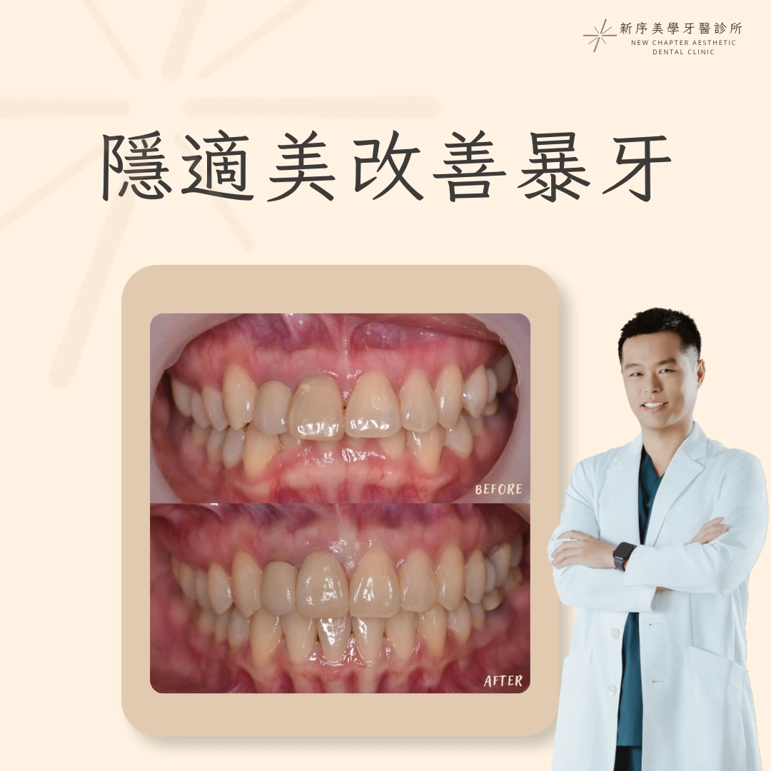 隱適美改善暴牙案例｜林建宏醫師案例分享