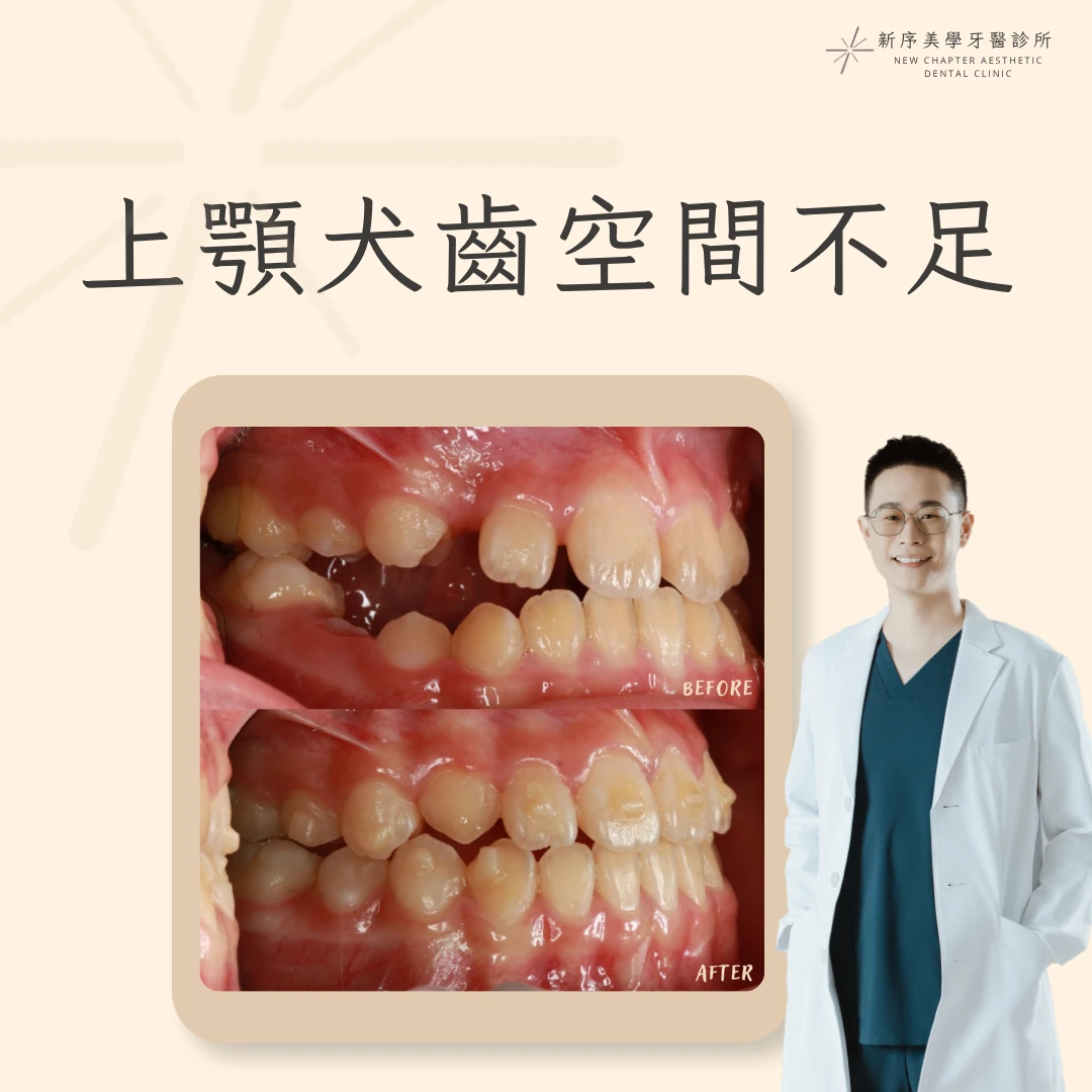 上顎犬齒空間不足案例 ｜黃冠華醫師案例分享