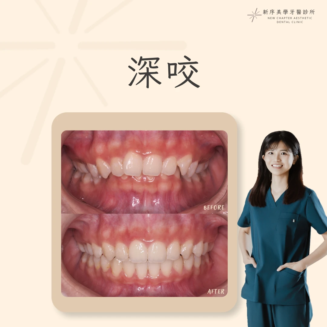 深咬案例 ｜黃愉惠醫師案例分享