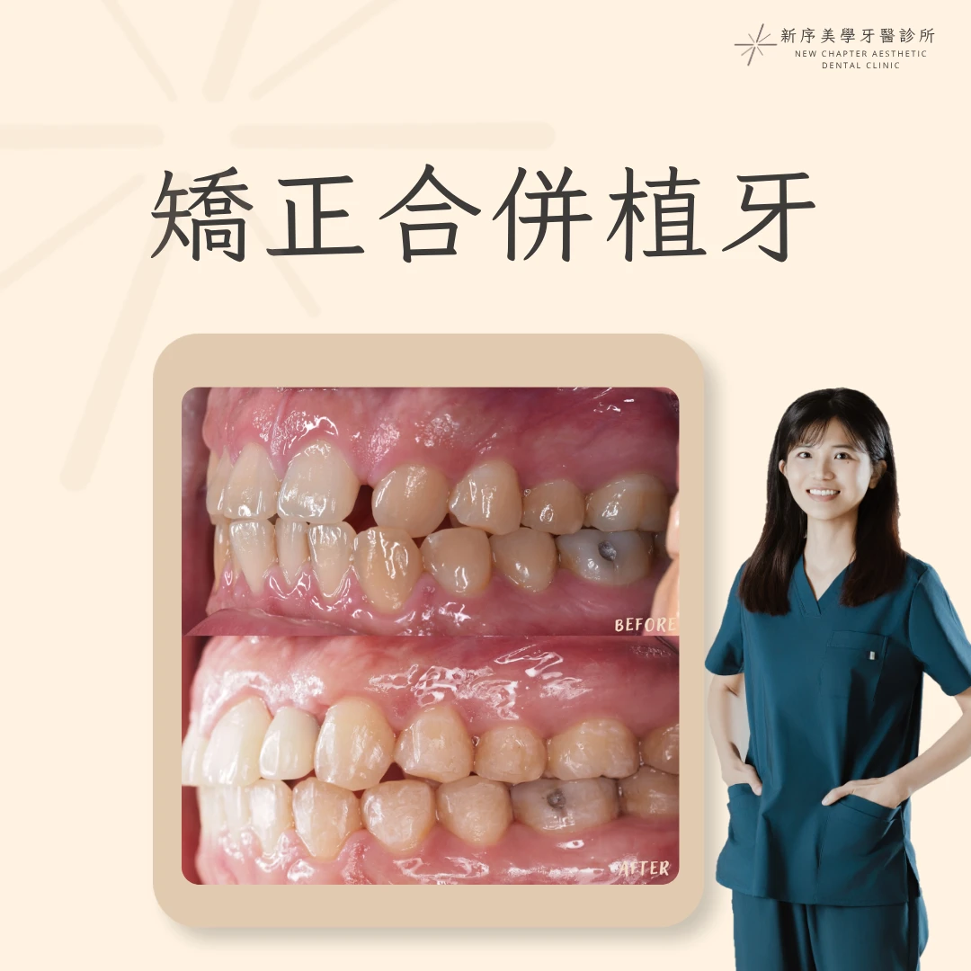 矯正合併植牙案例 ｜黃愉惠醫師案例分享