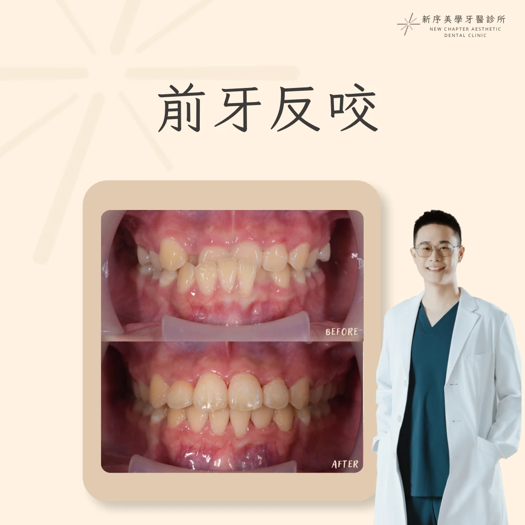 前牙反咬案例 ｜黃冠華醫師案例分享