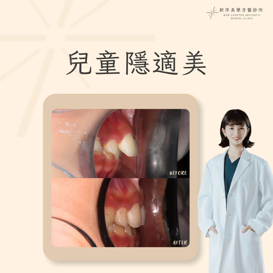 兒童隱適美案例 ｜郭亭余醫師案例分享