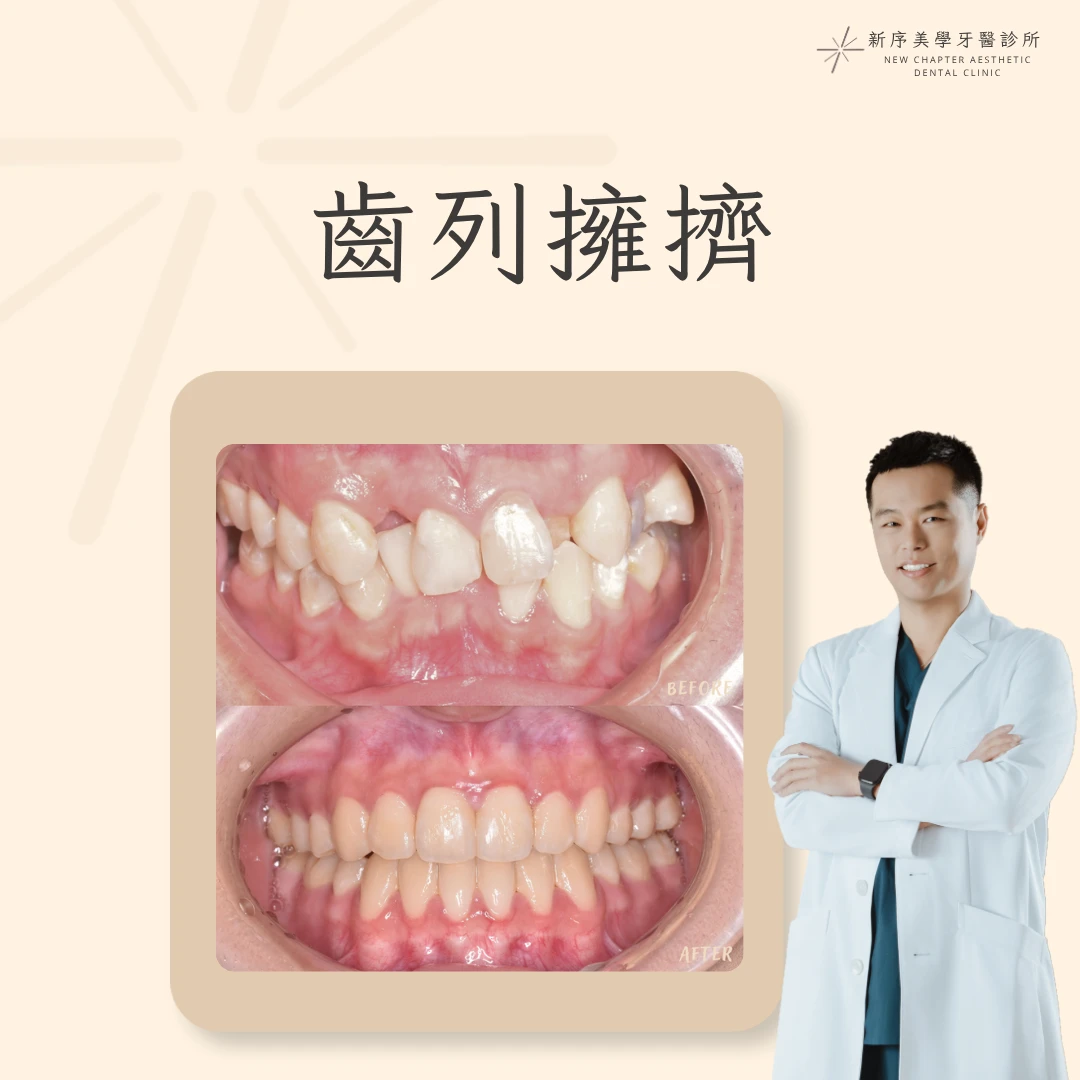 齒列擁擠案例｜林建宏醫師案例分享