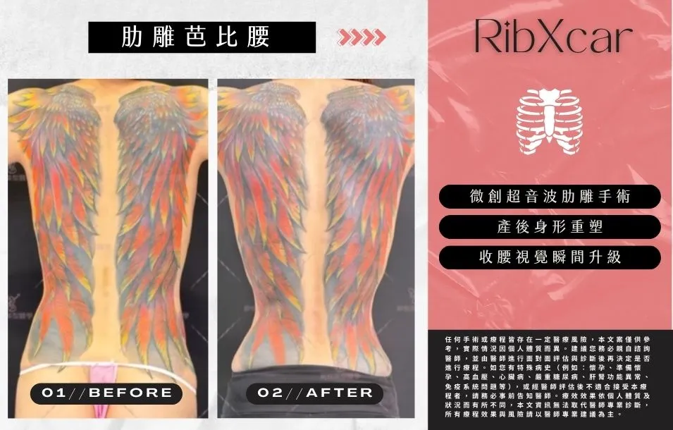 【肋雕芭比腰】案例01