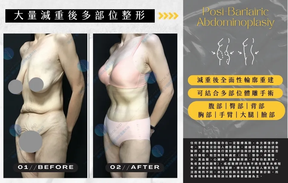 【大量減重後】多部位形體雕塑  - 雕塑迷人曲線
