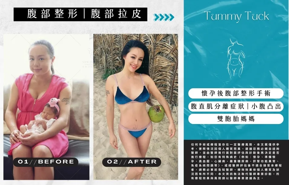 【 產後修復與腹部雕塑】腹部整形 - 雙胞胎媽媽