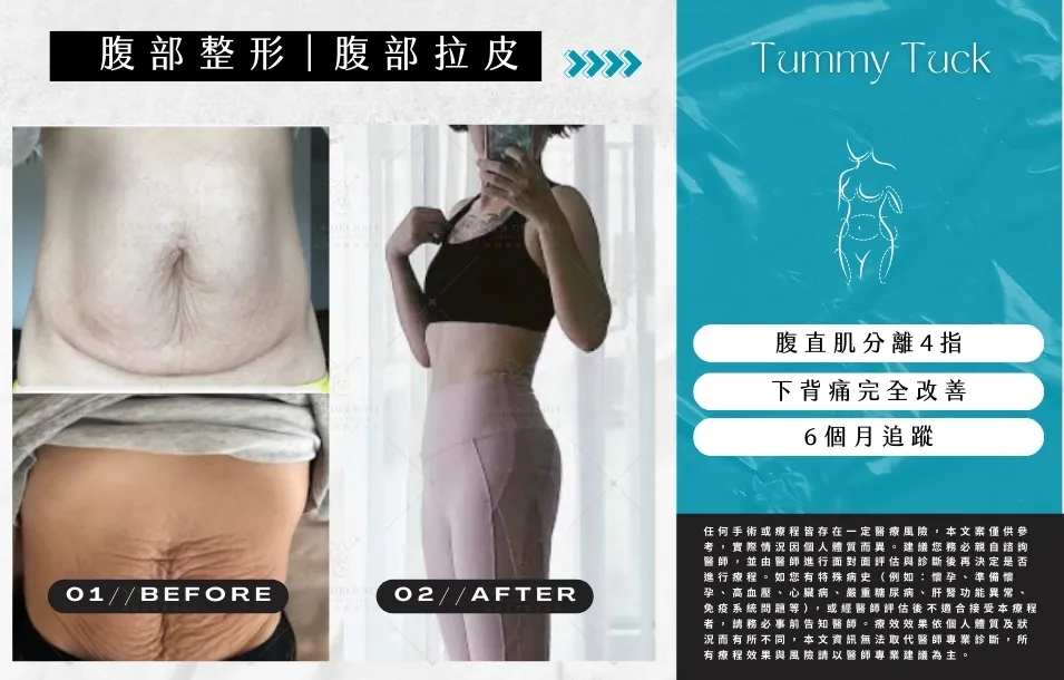 【 產後修復與腹部雕塑】腹部拉皮實際案例-25