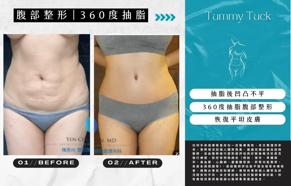 【 產後修復與腹部雕塑】腹部拉皮實際案例-26