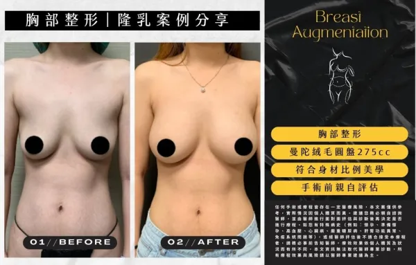 【胸型美學】隆乳實際案例-08