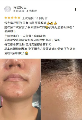 做完蠻舒服的 還有按摩 服務超好 清粉刺推薦,雲林清粉刺推薦,虎尾清粉刺推薦