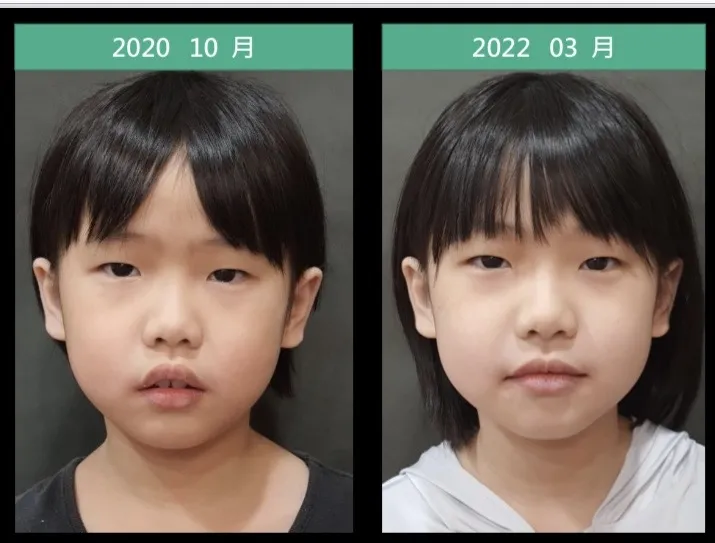 本季小公主之成長紀錄: 燦爛的笑容更有自信! 原本的口呼吸 鼻塞也改善了 認真戴牙套 認真做舌頭 口腔肌肉功能訓練動作 認真刷牙 就對了! (已徵求家屬同意之後貼出)