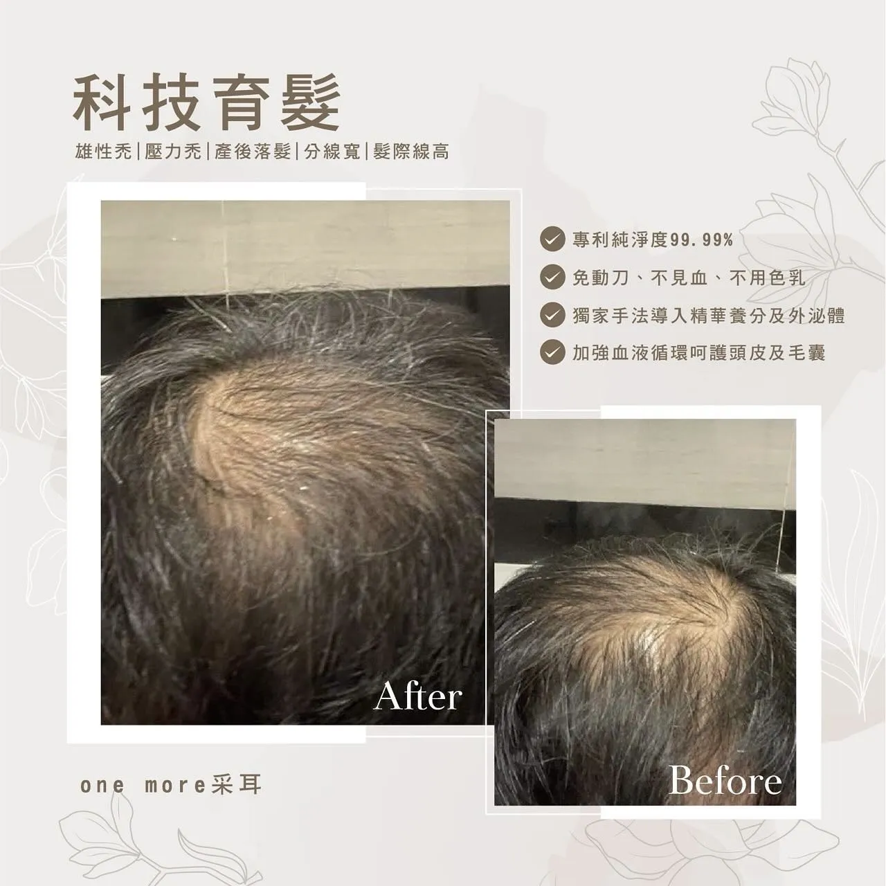 雄性禿｜壓力禿｜產後落髮｜分線寬｜髮際線高
