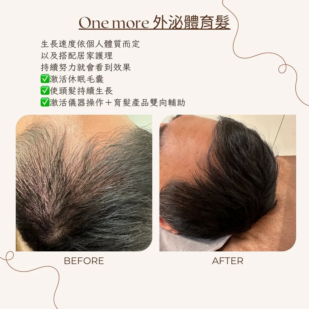 外泌體育髮