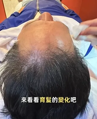 外泌體育髮
