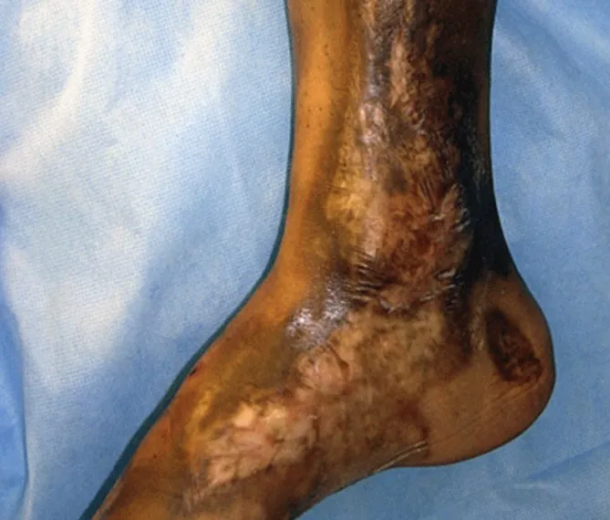 硬皮症、類風詩興關節炎、紅斑性狼瘡與【植物硒】