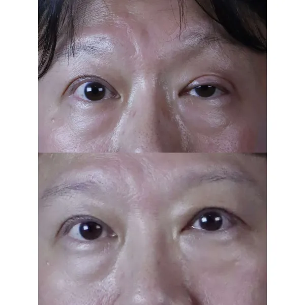 嚴重眼瞼下垂