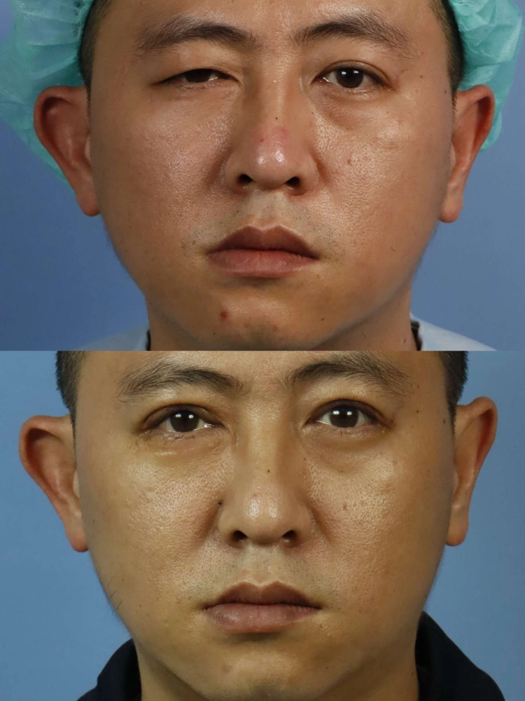 提眼瞼肌拉提手術