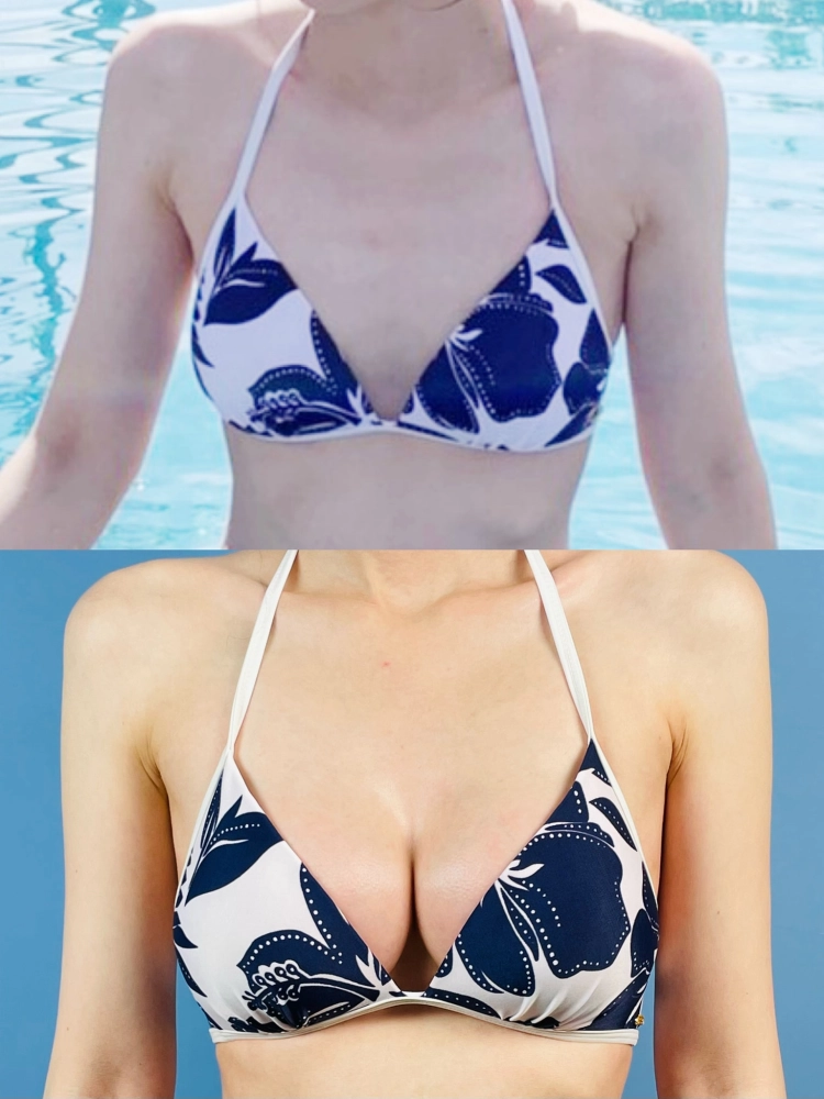 隆乳手術