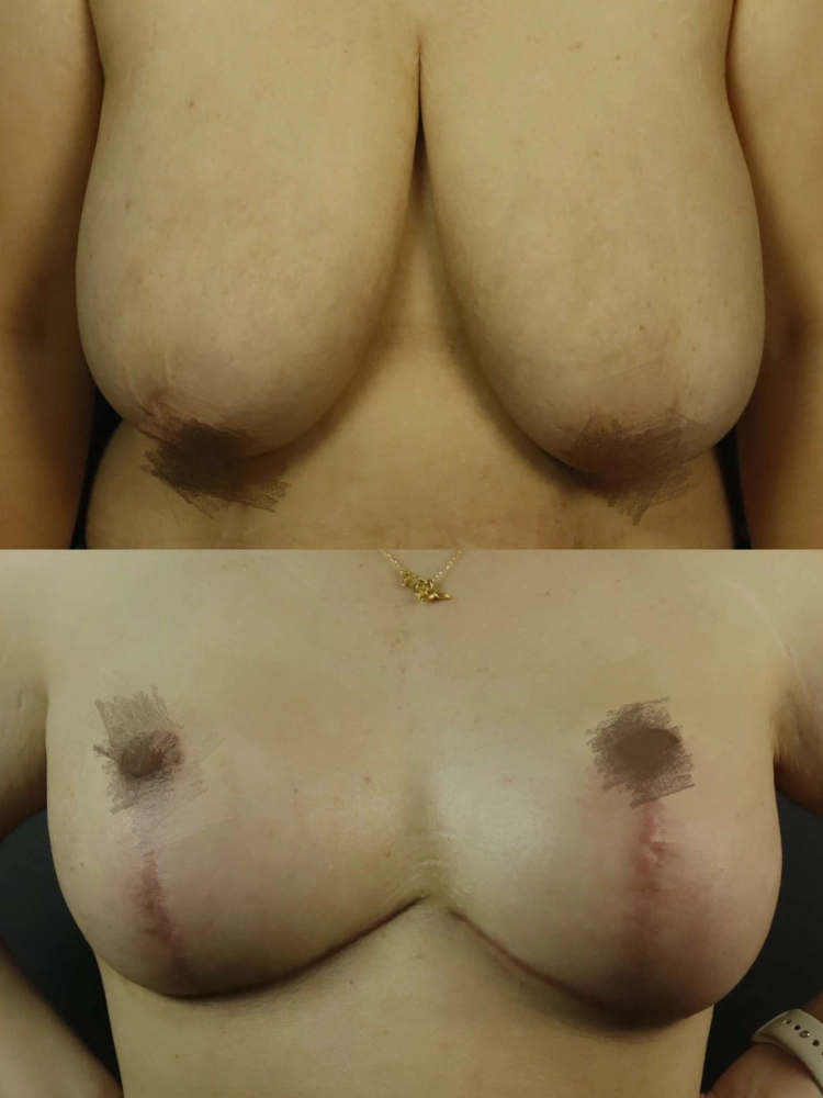 提乳手術