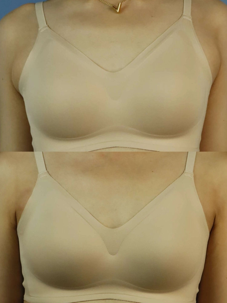 副乳手術