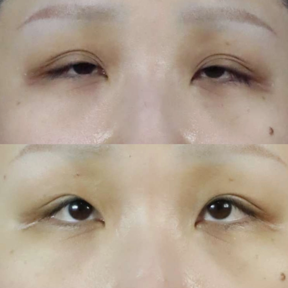 提眼瞼肌拉提手術