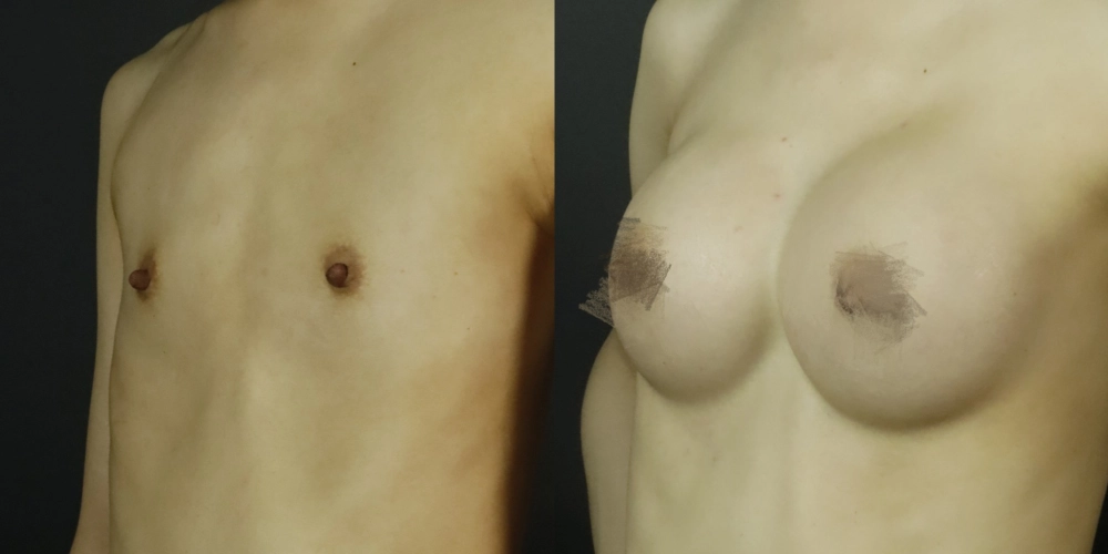 隆乳手術