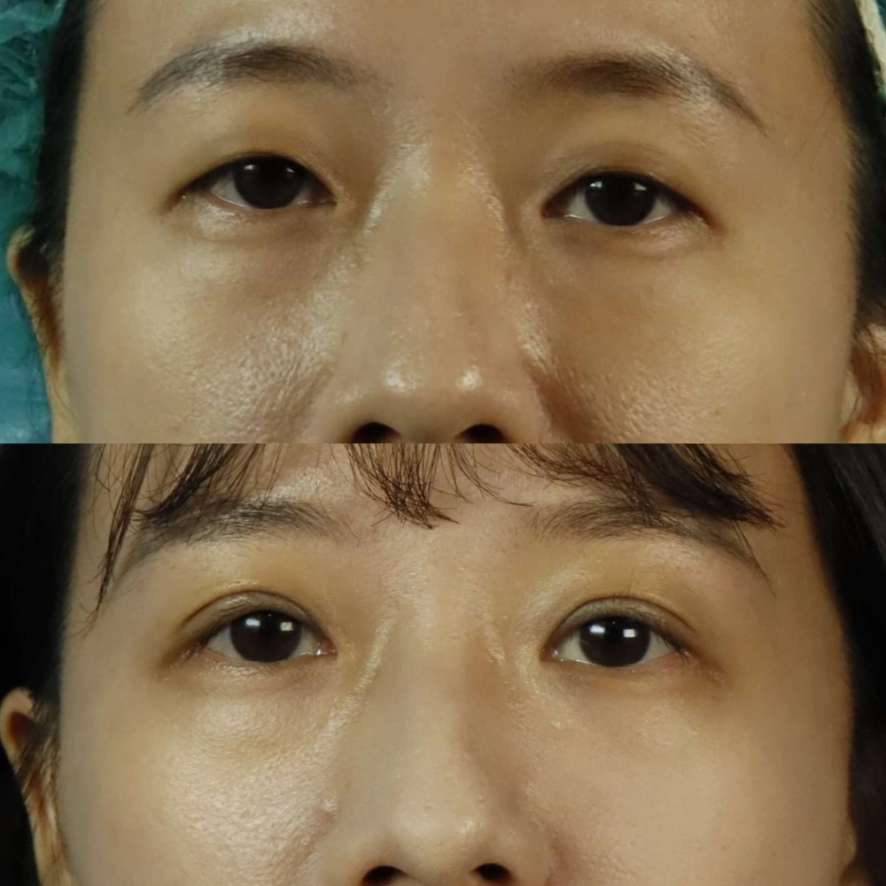 提眼瞼肌拉提手術