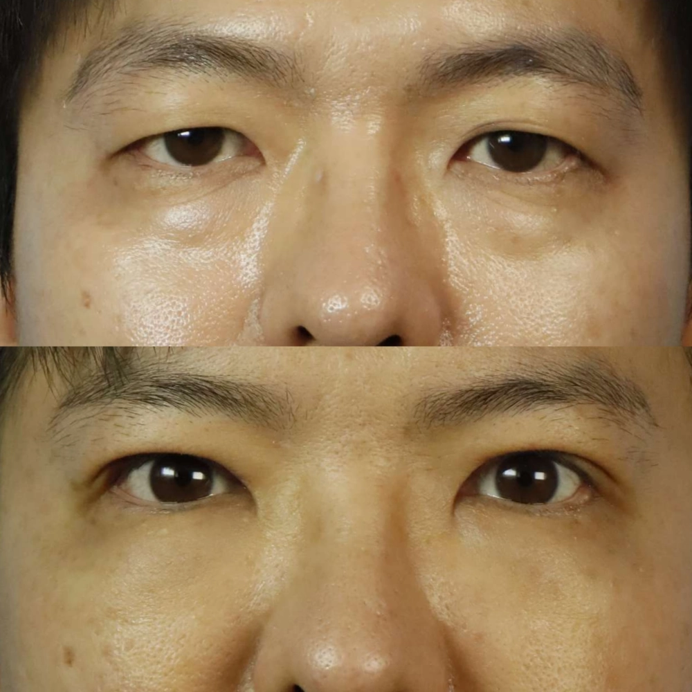 提眼瞼肌拉提手術
