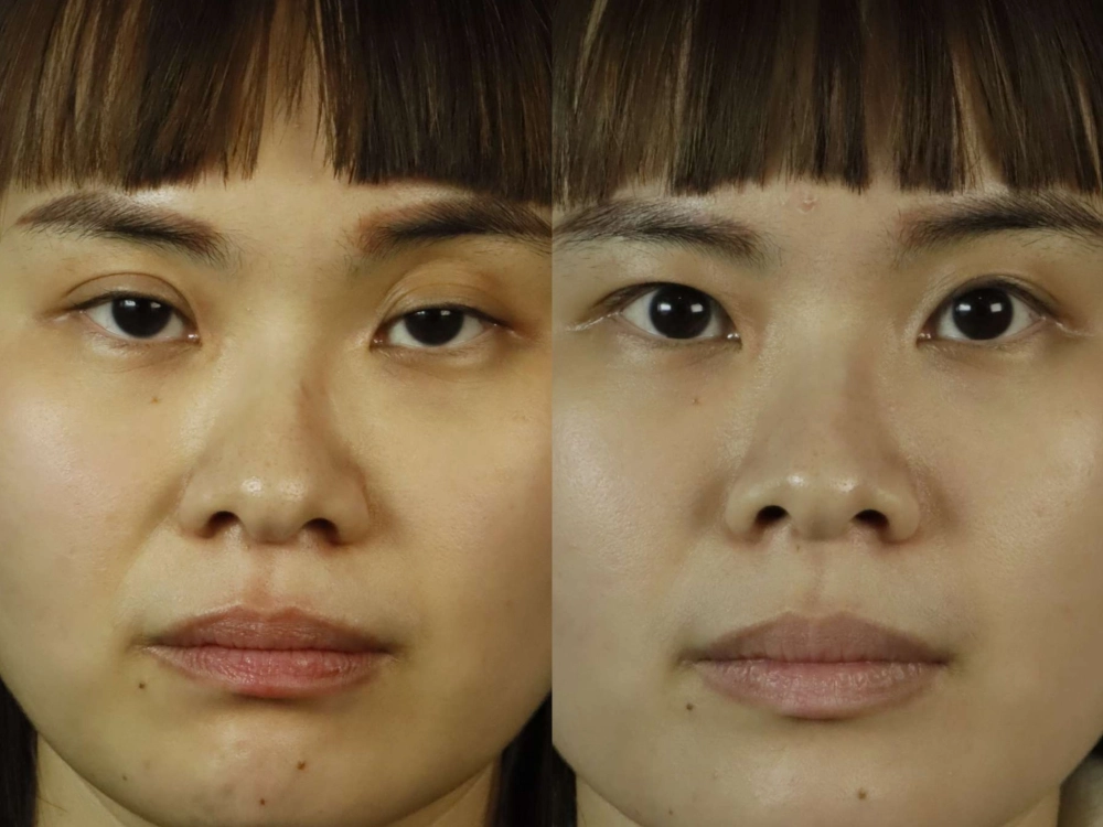 提眼瞼肌拉提手術