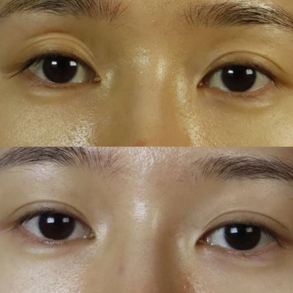 提眼瞼肌拉提手術