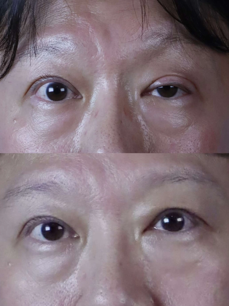 提眼瞼肌拉提手術