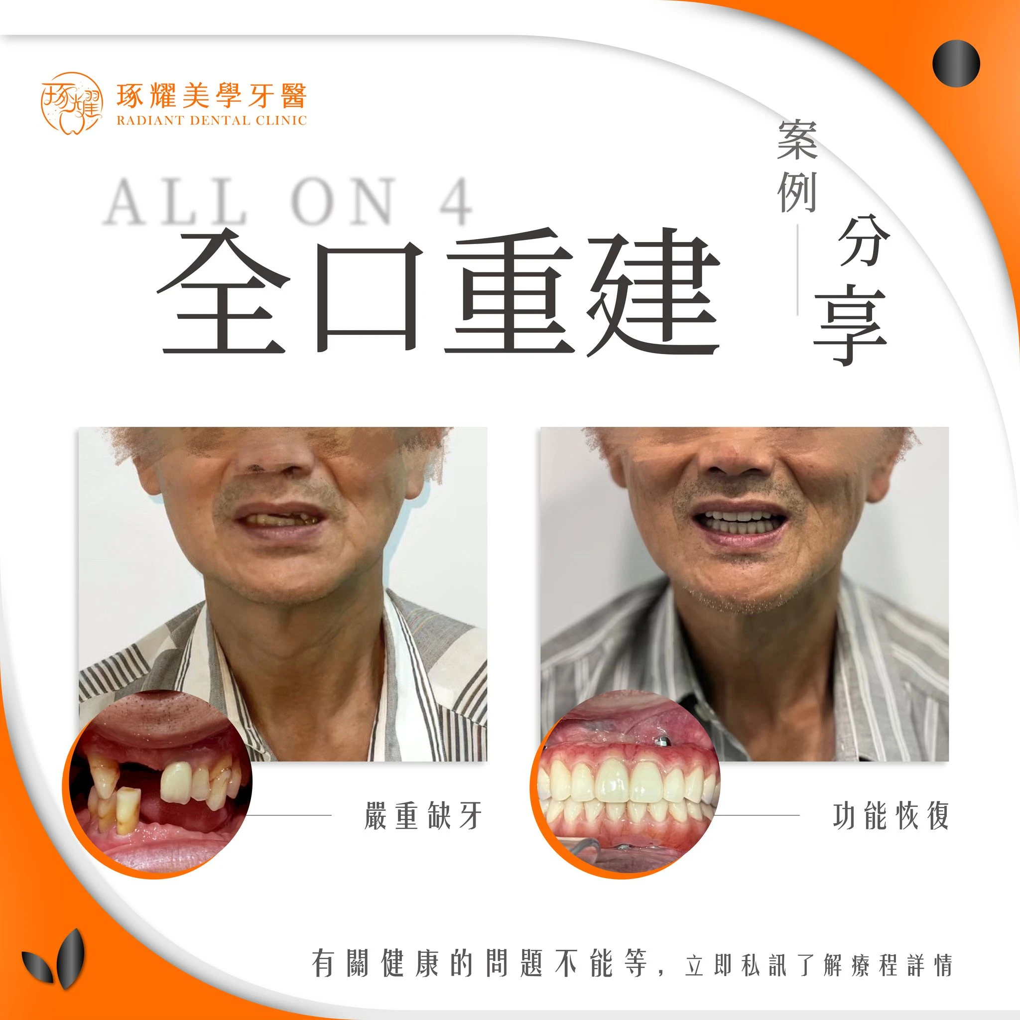 #真實案例分享 #ALLON4全口重建