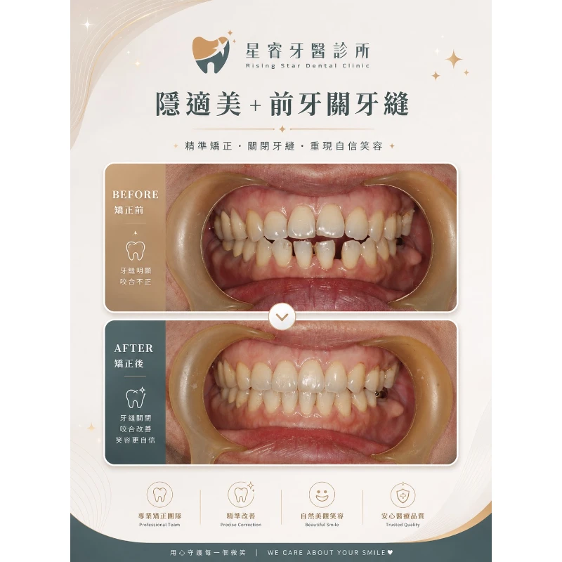 隱適美+前牙關牙縫