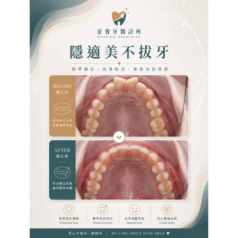 隱適美不拔牙