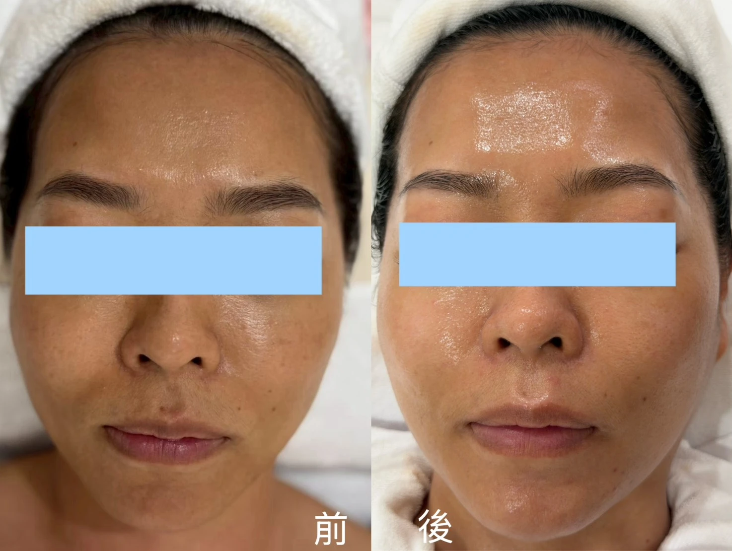 修緹紗膠原水光課程
