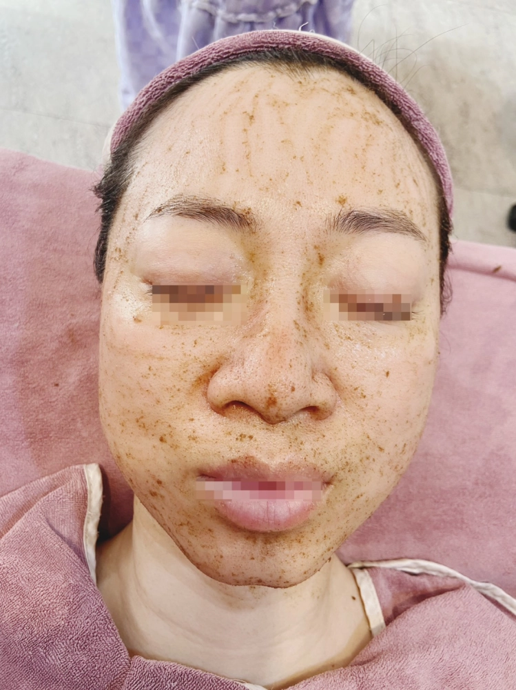 深層矽藻微針