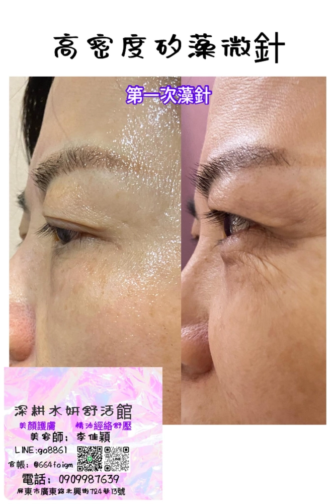 高密度矽藻微針