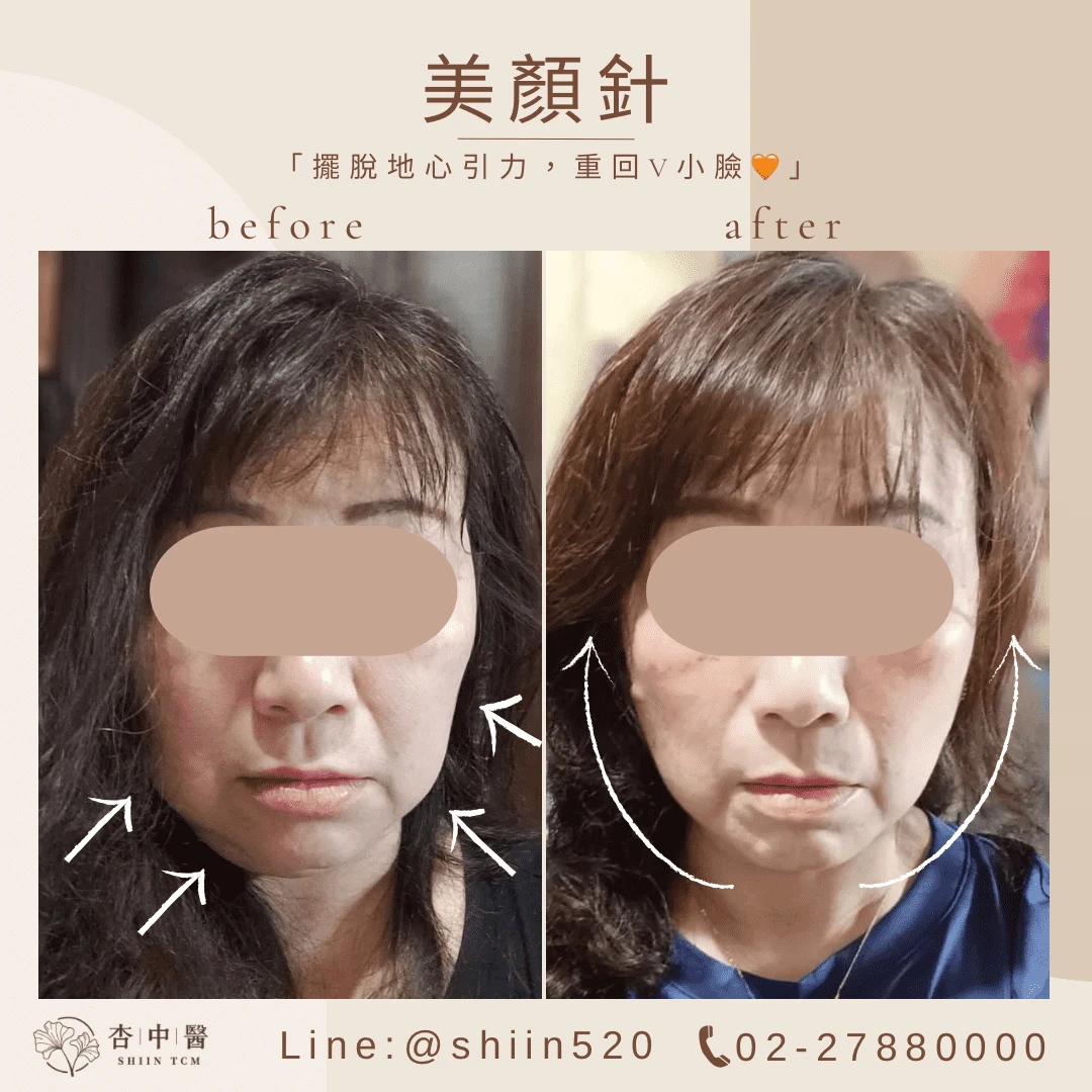 美顏針