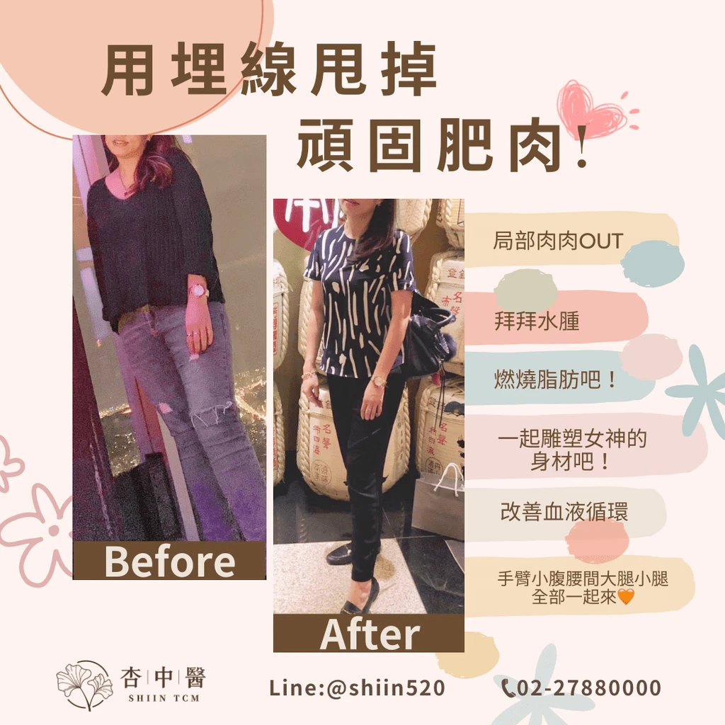 用埋線甩掉頑固肥肉