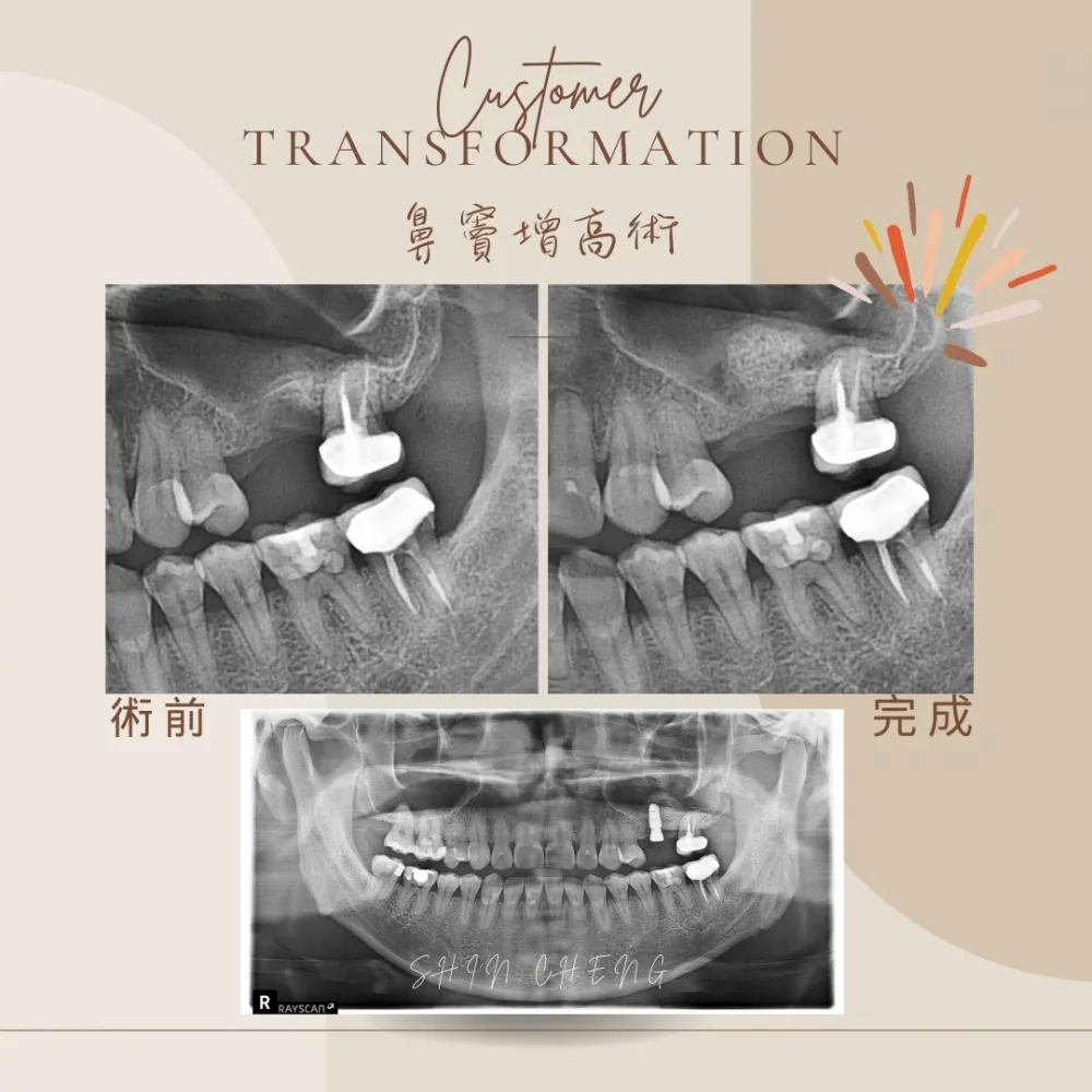 鼻竇增高術