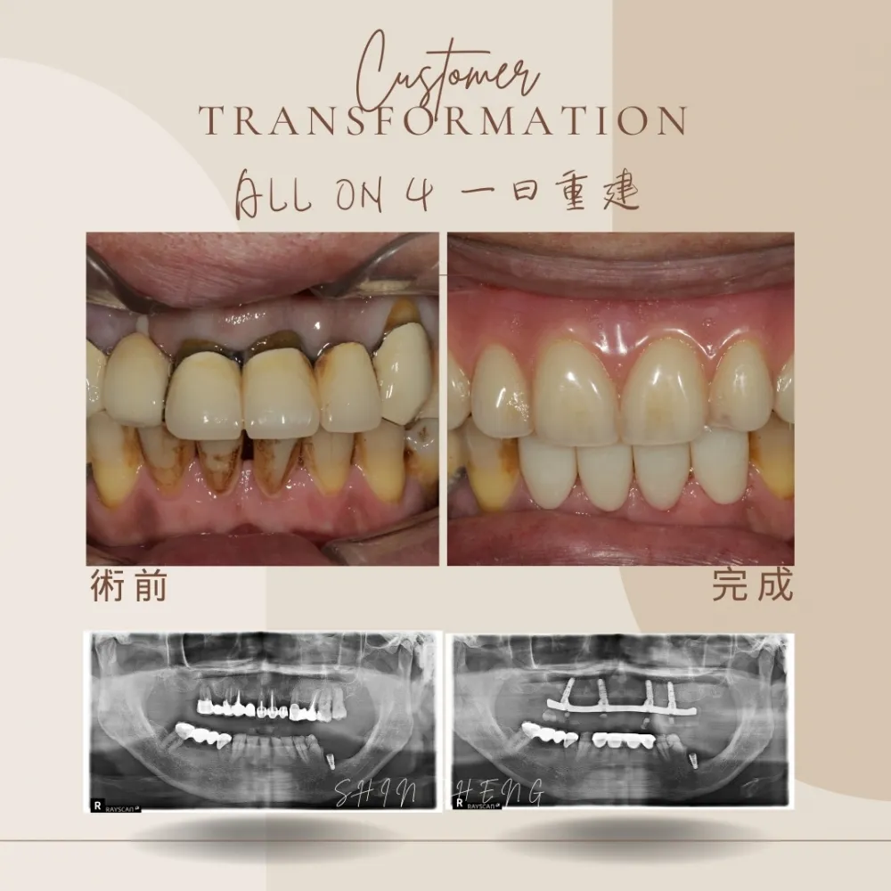all on 4全口重建