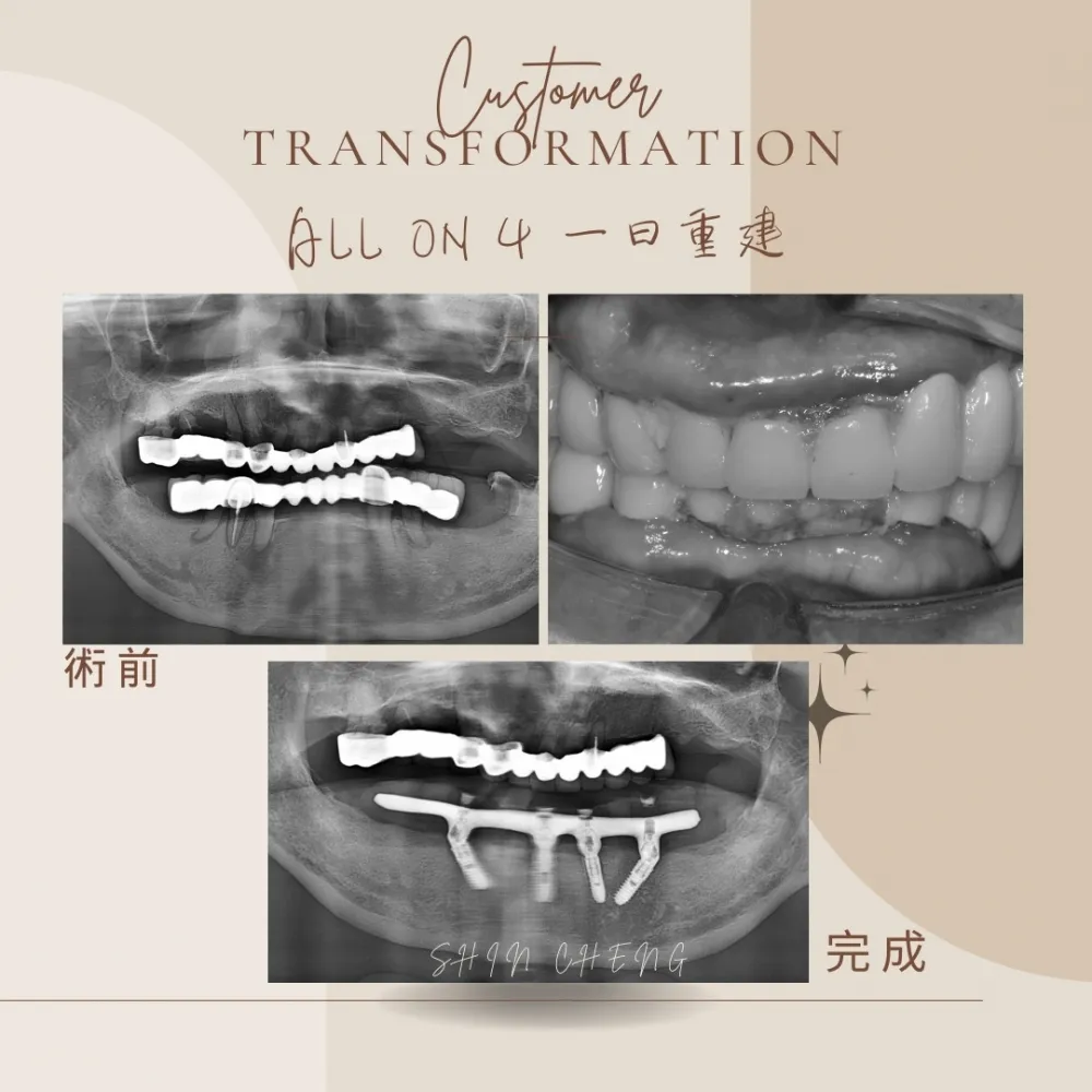 all on 4全口重建