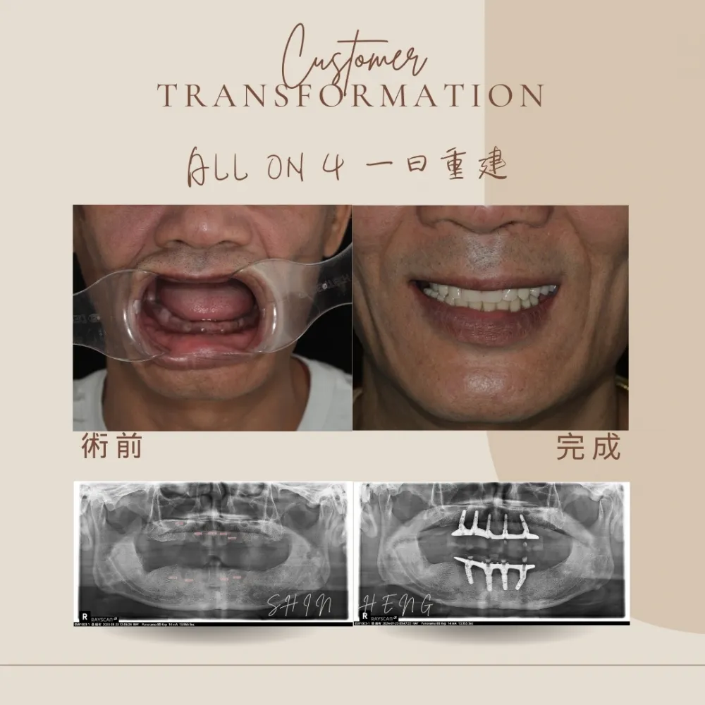 all on 4全口重建