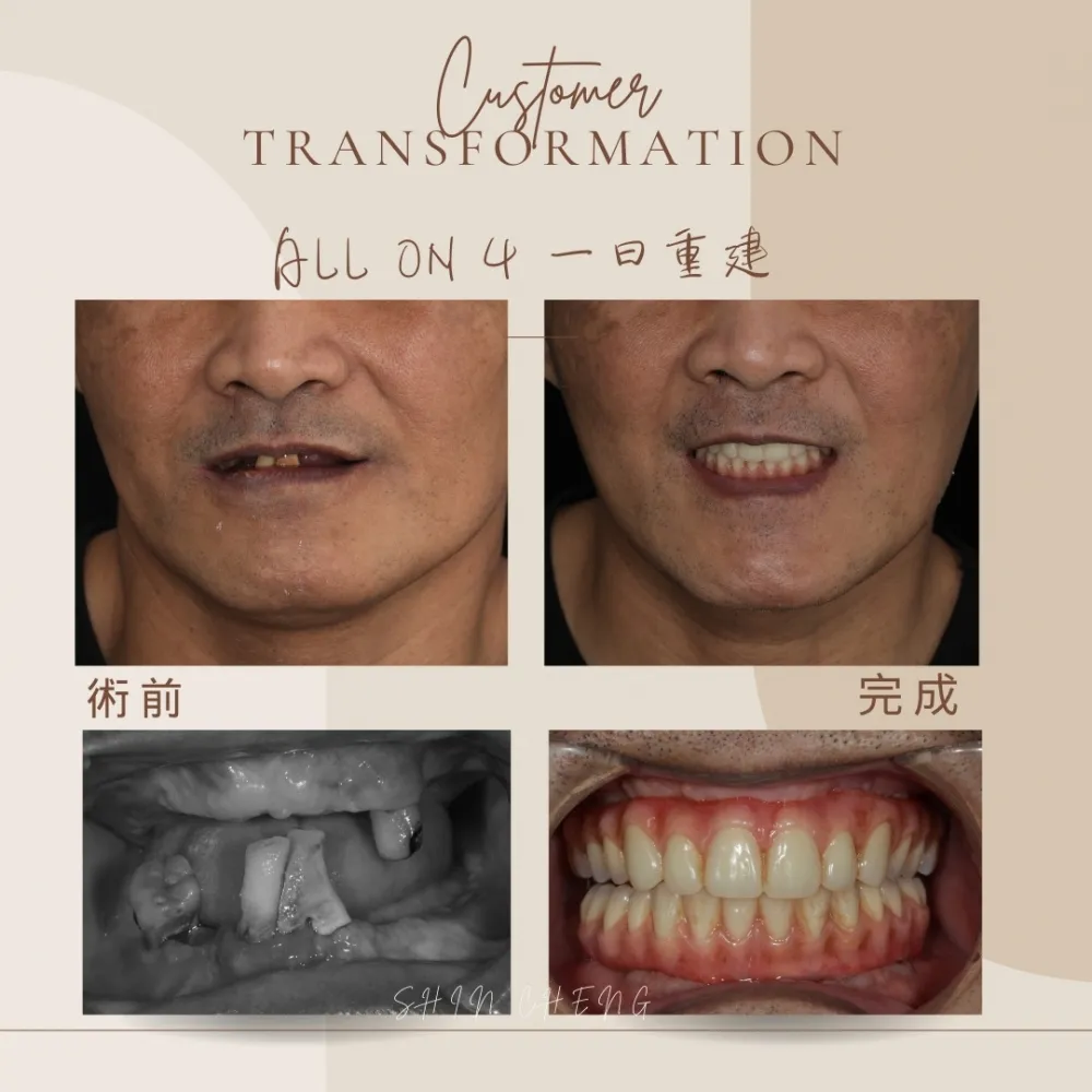 all on 4全口重建