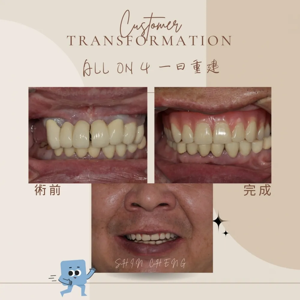 all on 4全口重建