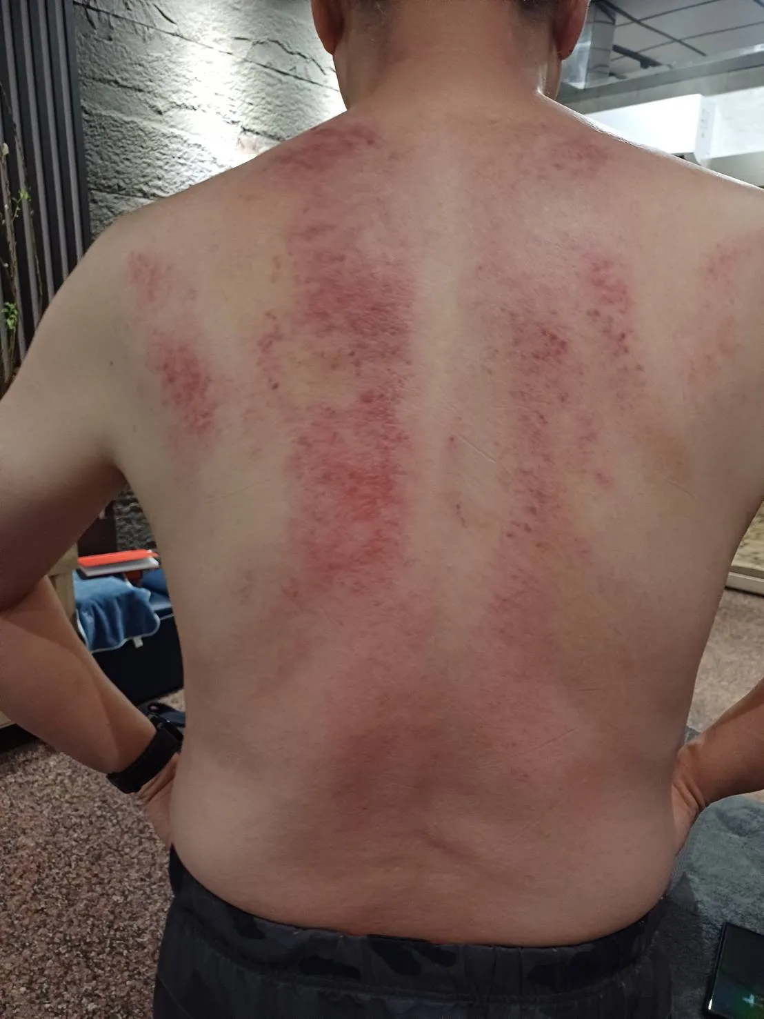 中暑該刮痧嗎? 哪時候要刮痧? / 高雄刮痧按摩,高雄刮痧拔罐,左營刮痧按摩,左營刮痧拔罐