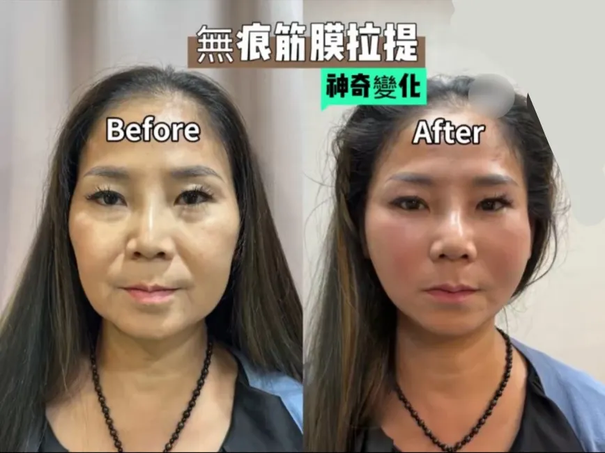 鬆弛感、嘴邊肉、法令紋讓你越來越在意了嗎？