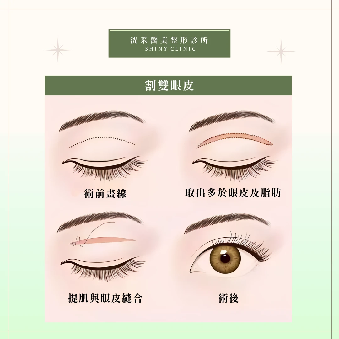 雙眼皮/提眼肌