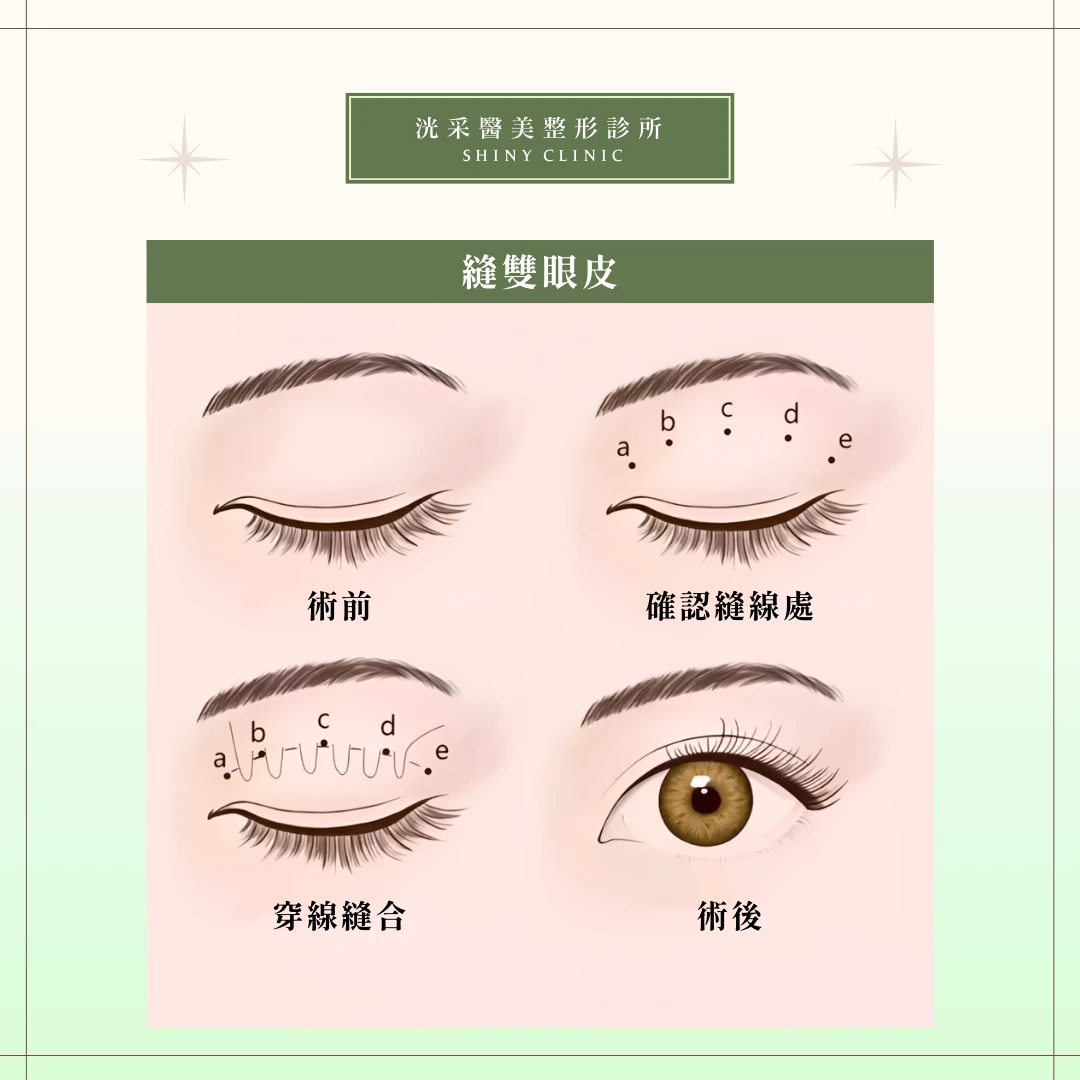 雙眼皮/提眼肌